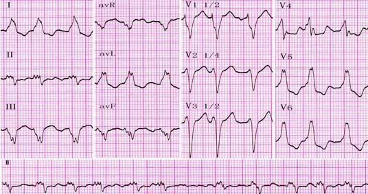 这7例心电图容易被误诊!