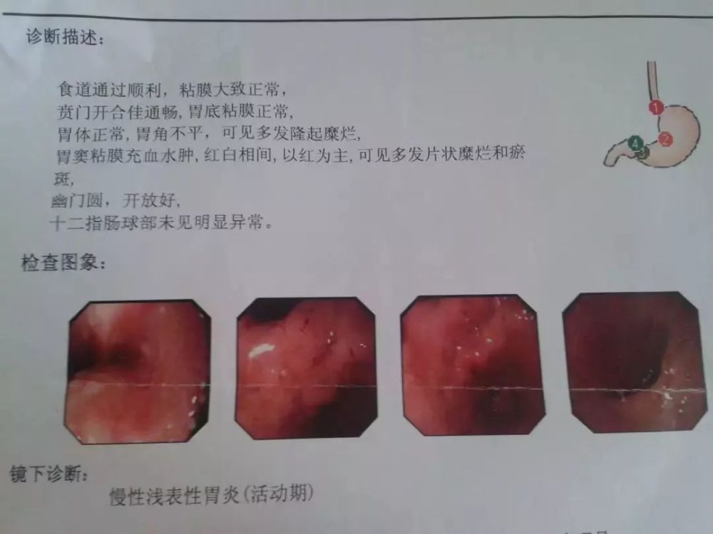 充血性红斑与黏膜水肿区交叉存在,致使该区域在红色充血底面上有淡