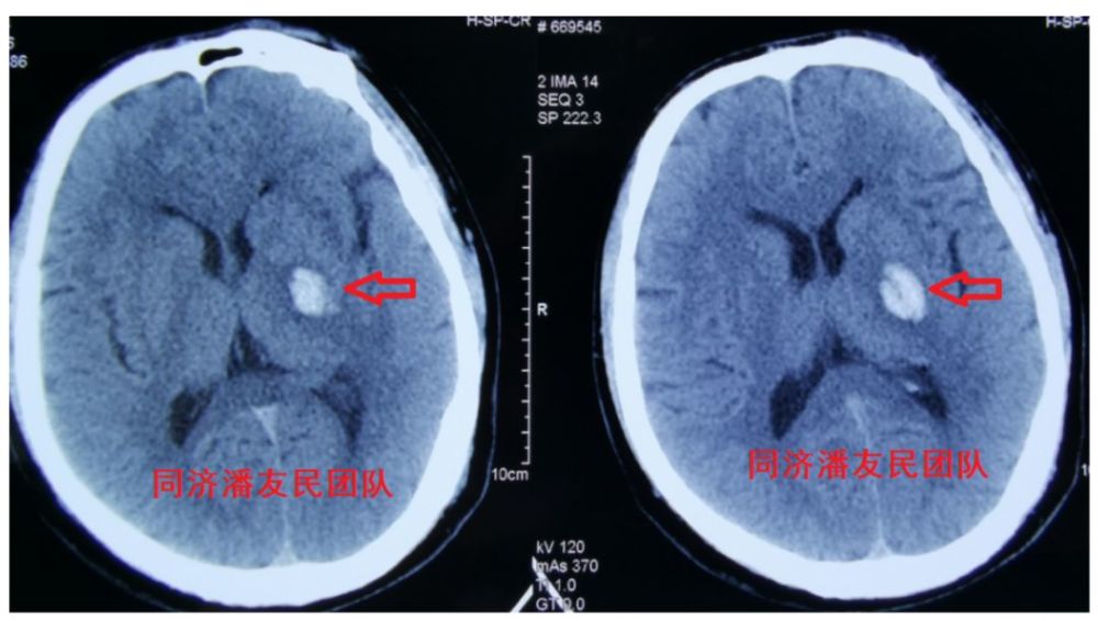 头部平扫ct显示脑出血(图2,红箭头所指).