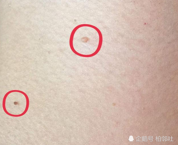 脖子上长出"小肉粒"?别只顾影响美观,或许是身体发出