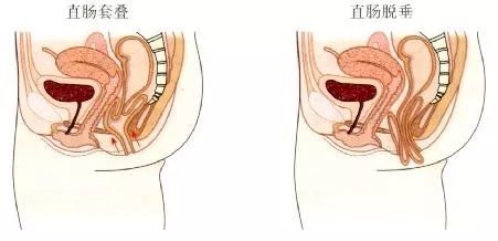 如何定义脱肛_腾讯新闻