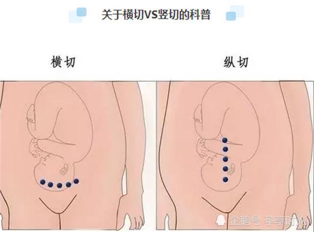 剖腹产还有讲究?横竖都是一刀,到底有啥不同