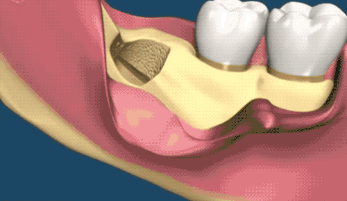 医师表示,由于患者的智齿位置深,朝舌向倒置生长,紧贴下牙槽神经管