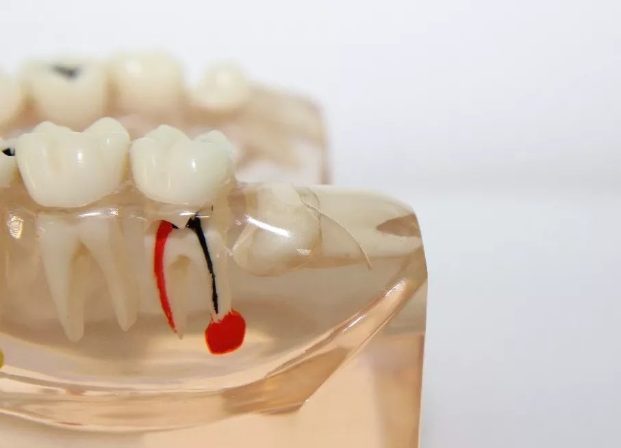 侵犯邻牙:由牙医以x光诊断得知,智齿萌发的空间不足,会倒在第二大臼齿