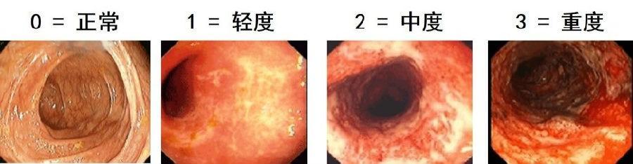 不要医生模糊答案!一篇教你看懂自己的溃疡性结肠炎到底重不重?