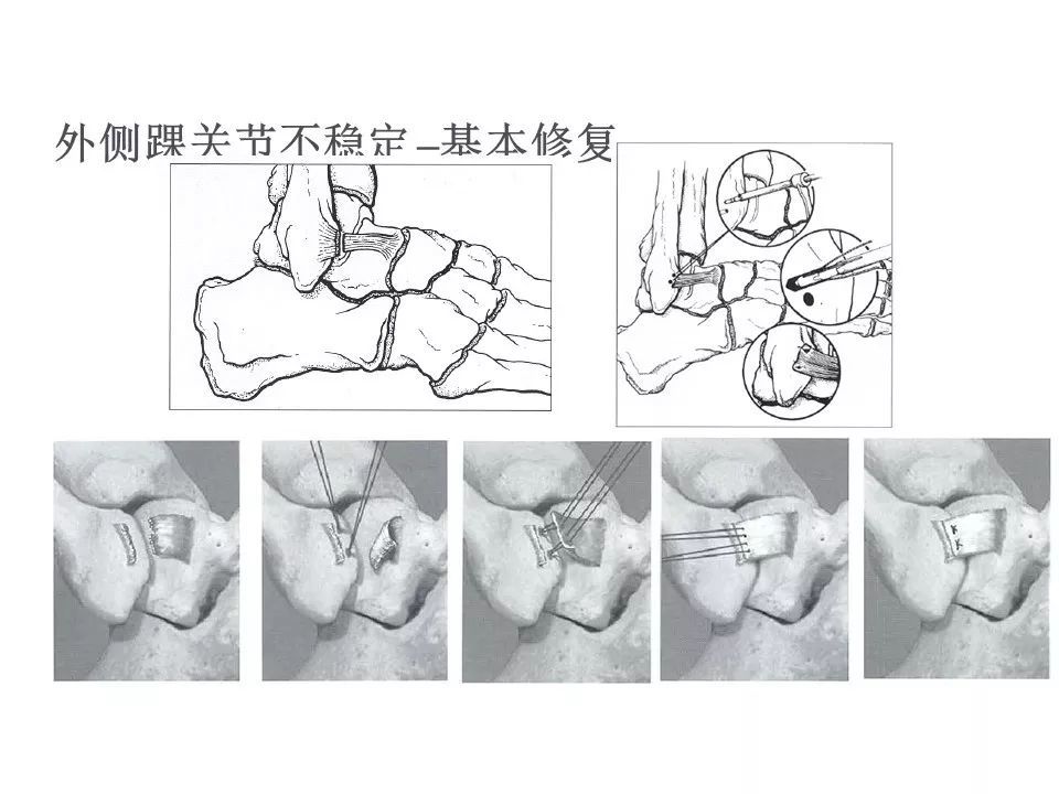 【德医骨科】实用,带线锚钉在创伤骨科的应用!