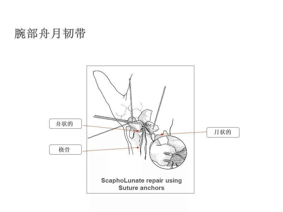 【德医骨科】实用,带线锚钉在创伤骨科的应用!