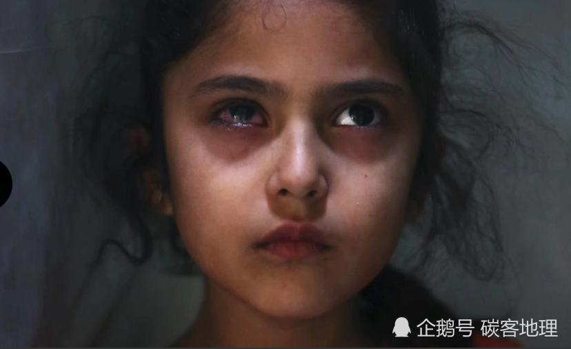 克什米尔6岁女孩眼睛被橡皮子弹击中留下永远悲伤的眼神