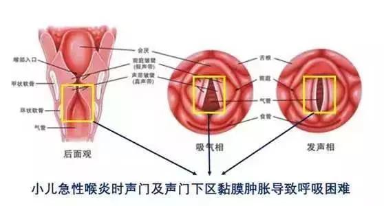 病情加重期:一般白天病情较轻,夜间加重,夜里常常因喉头炎症迅速发展