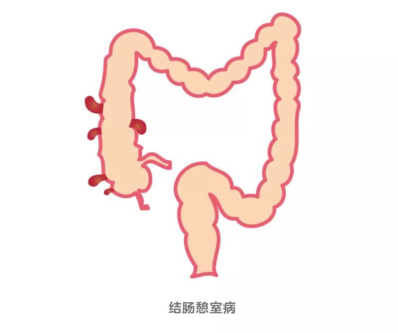 大便出血是否代表严重疾病