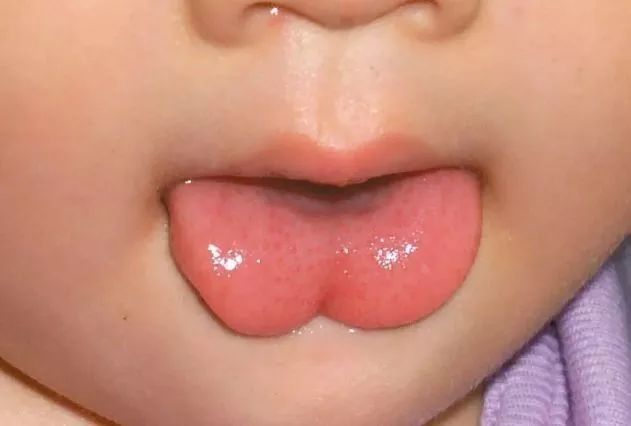看看孩子的舌头,这种形状一定要注意