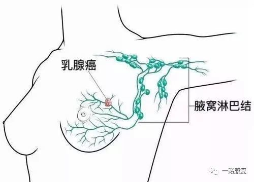 对于乳腺癌女性患者,与腋窝淋巴结清扫(axillary node dissection