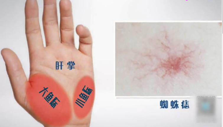 肝掌和蜘蛛痣是肝病的典型临床表现,如果手掌出现肝掌,胸部和手臂出现