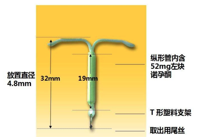 曼月乐环——妇科医生的法宝