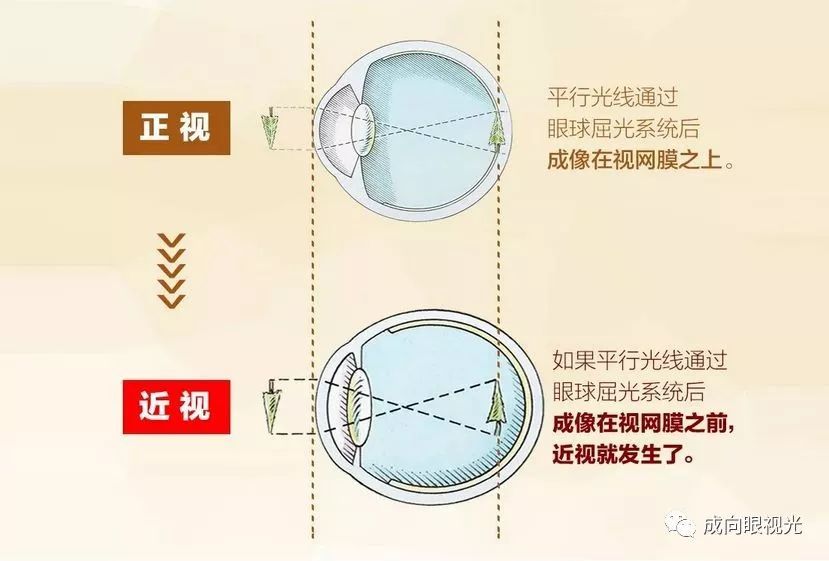 爱眼课堂你的孩子近视吗