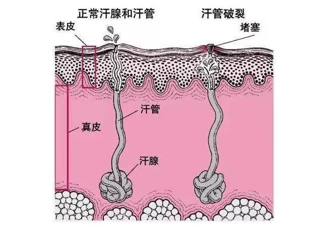 又或者是因为汗腺分泌失常,分泌