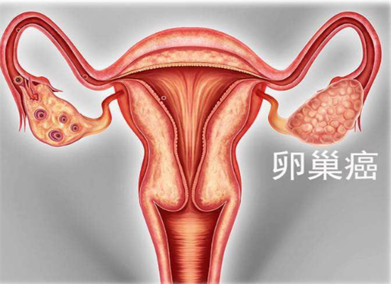 "卵巢癌"初期不疼不痒,若身体有"这3处"不适,八成已