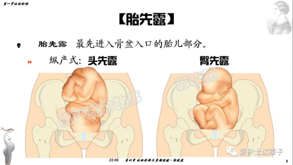 在纵产式有 头先露及臀先露, 头先露可以解释为胎儿的头部最先进入