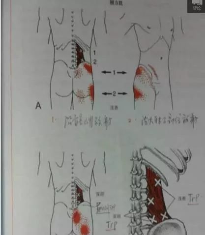 腰方肌相关诊疗