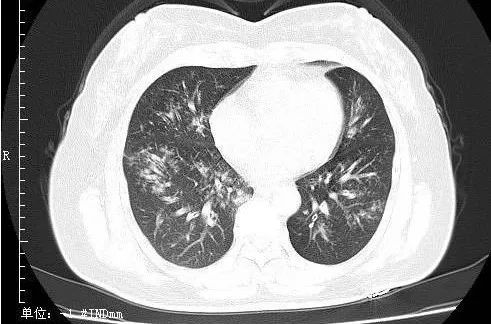 病例 1:同一小叶性肺炎患者于同日拍摄的胸片和肺 ct.
