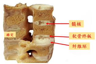 科学认识腰椎间盘突出症,走出"别人都说"的误区