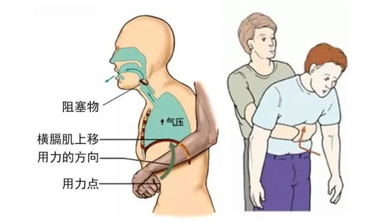 重温海姆立克急救法,凯格尔训练|应对大小朋友呛食,仙女麻麻的尿频