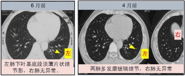 双肺多发磨玻璃结节,是肿瘤还是感染?