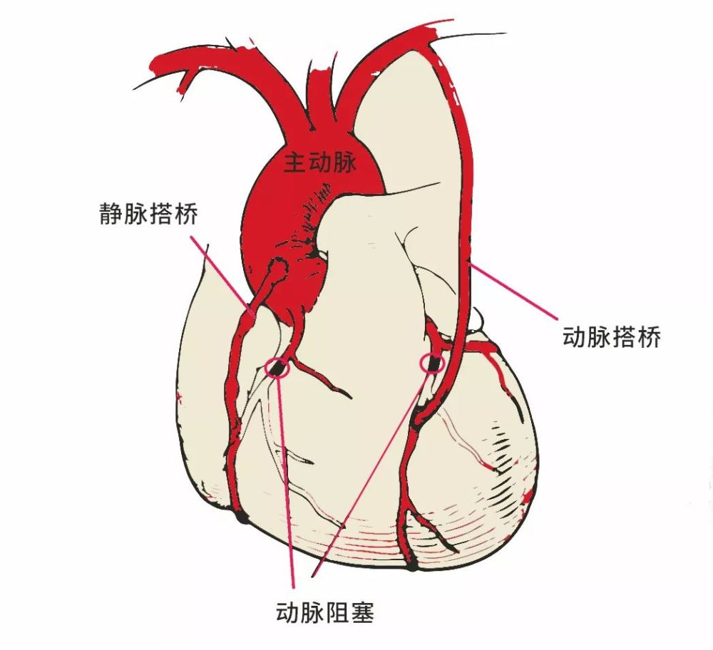 在跳动的心脏上缝合血管