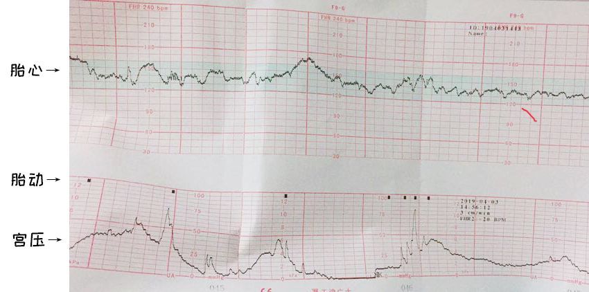 具体的监护时机依据妊娠合并高危因素的不同而不同,对于胎死宫内发现