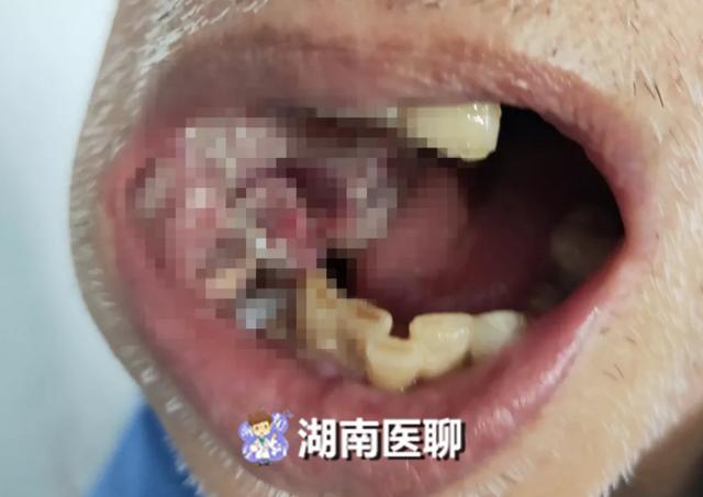 大爷口中长出5公分肿物!舌头几乎无法运动,不手术就能