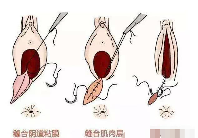 顺产侧切能有多痛呢?