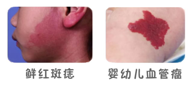如何区分鲜红斑痣和血管瘤