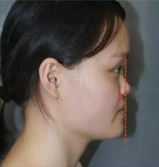 是你哦~ 如果额头和下巴都不过分突兀,但面型像下图一样属于凹面型的