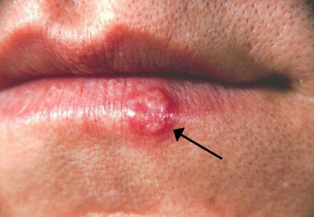 这种常见的唇边起泡,即所谓的"上火",其实是感染了单纯疱疹病毒