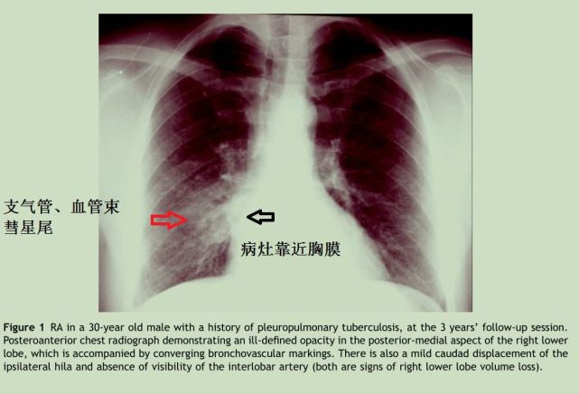 例8:圆形肺不张胸片表现