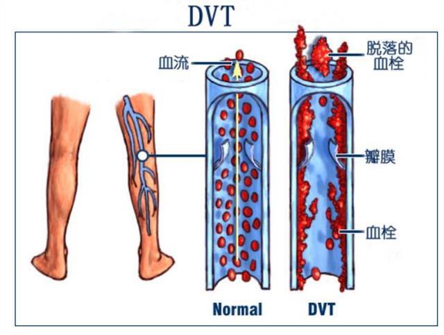 绝大多数静脉血栓形成发生在盆腔及下肢的深静脉,多见于产后,骨折及