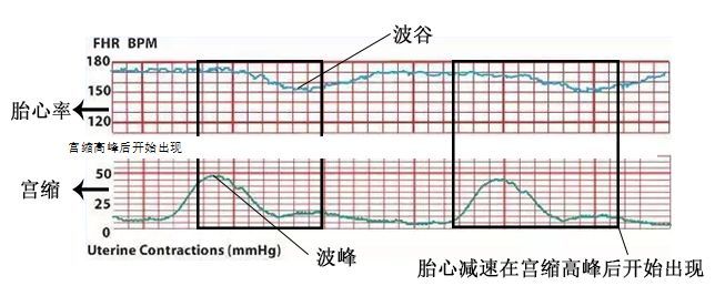 4个小技巧,绕开胎心监护"小陷阱"!告别胎监不合格