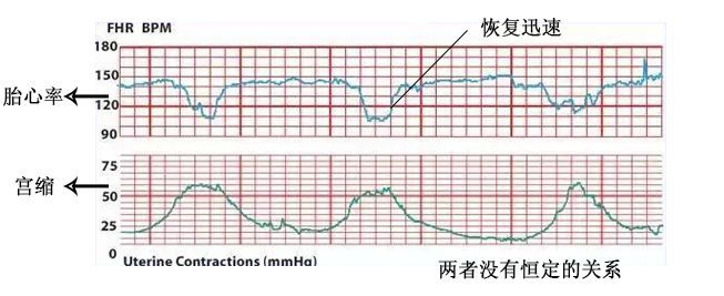 早期减速: 晚期减速: 变异减速: 我们不仅仅要关注胎心率,还要密切