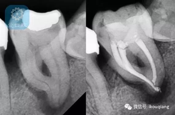 首先初步探测穿孔的位置及深度,穿孔下可以进行常规填充,对于穿孔