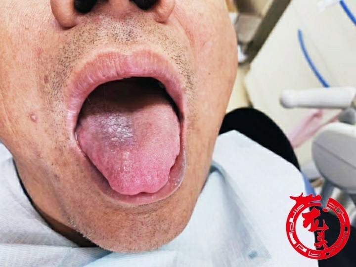 47岁的哈尔滨市民王新(化名)近日在医院检查了自己舌头上的白斑,被