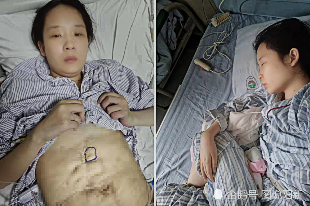 美女剖腹产后患疑难病,辗转10多家名医院无疗效,靠"吸毒"活命