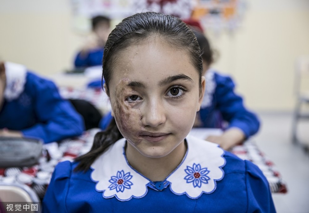 战争留在了她脸上9岁女孩叙利亚冲突中失去父母严重烧伤心疼