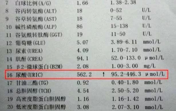 睡觉时若出现这3种表现最好检查一下尿酸值可能肾衰竭要来了