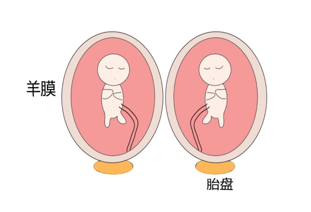 单卵双胎