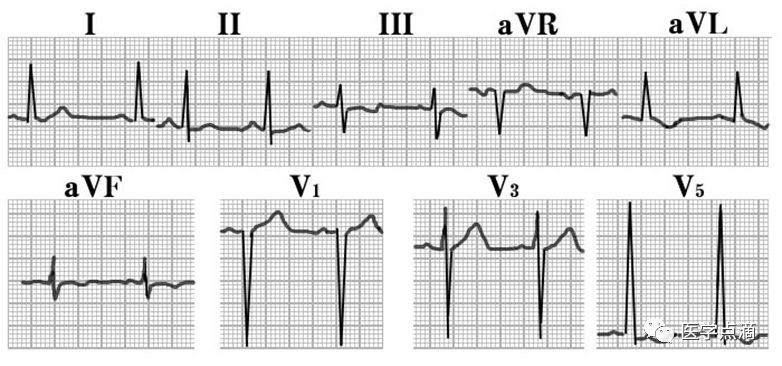 心电图知识学习,干货满满!送给需要的人