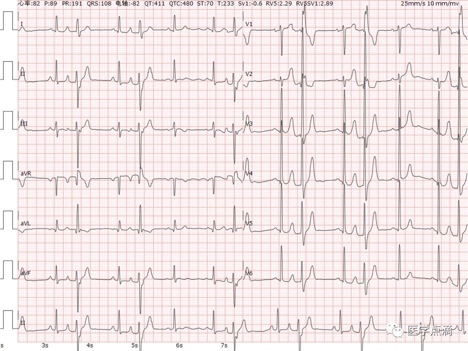 20s:Ⅰ度房室传导阻滞;p波在qrs前面的交界性心律失常 早搏的鉴别