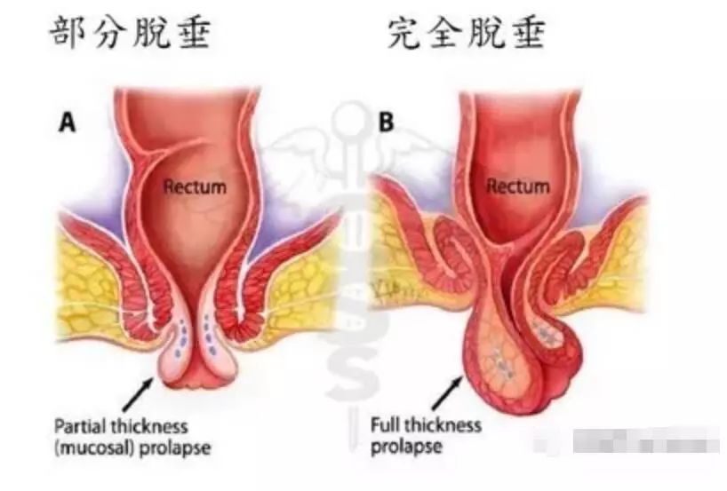 脱出部分在肛管直肠内称为内脱垂或内套叠,脱出肛门外称为外脱垂.