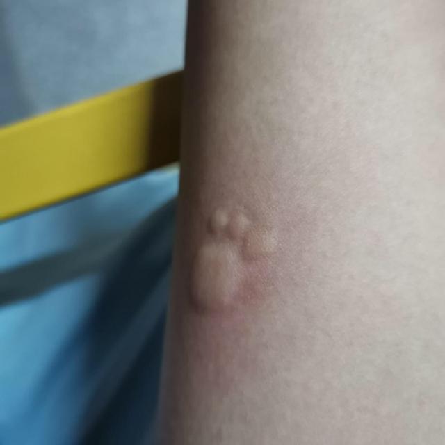 网友吐槽说自己被蚊子咬了,但是这被咬的小包包也太萌
