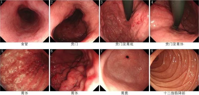 医生从早期胃癌,食管颗粒细胞瘤等的内镜诊治中学到了什么?