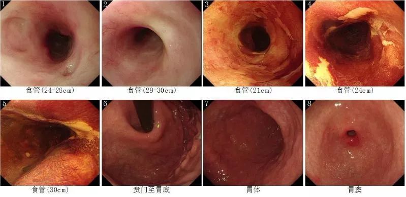 医生从早期胃癌,食管颗粒细胞瘤等的内镜诊治中学到了